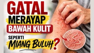 Gatal Merayap Bawah Kulit Seperti Miang Buluh